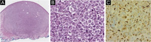 (A) Specimen (10× magnification) with hematoxylin-eosin showing a well-defined non-encapsulated tumor in the dermis (Hematoxylin eosin). (B) A magnification (200×) with hematoxylin-eosin showing small to medium monotonous cells with an epithelioid/lymphomyeloid appearance and abundant mitosis. (C) CK20 (200× magnification) immunohistochemistry in perinuclear dot-like pattern.