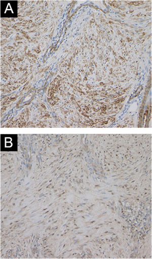 Hypertrophic scar mimicking peristomal pyoderma gangrenosum | Anais ...