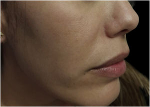 Three months after concomitant use of pharmacotherapy and IPL.
