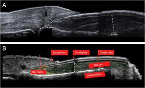 (a) High-resolution skin ultrasound with Doppler analysis performed with a 22 Mhz translator showed thickening of the nail bed with hypoechoic appearance. It measured 4.4 mm and did not show any signs of hypervascularization on the Doppler exam. However, it did show a reduction in the space between the origin of the nail plate and the base of the distal phalanx: its measure was approximately 3.5 mm and presented a hypoechoic inflammatory halo. (b) Normal anatomy of the nail.