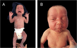 A and B: At 28 days of life, congenital telangiectatic cutis, aberrant mongolian spots and nevus flammeus on the face.