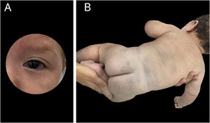 A and B: At six months of life, extensive mongolian spots and gray sclerae.