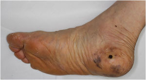 Clinical presentation. Multiple pigmentation patches on the heel.