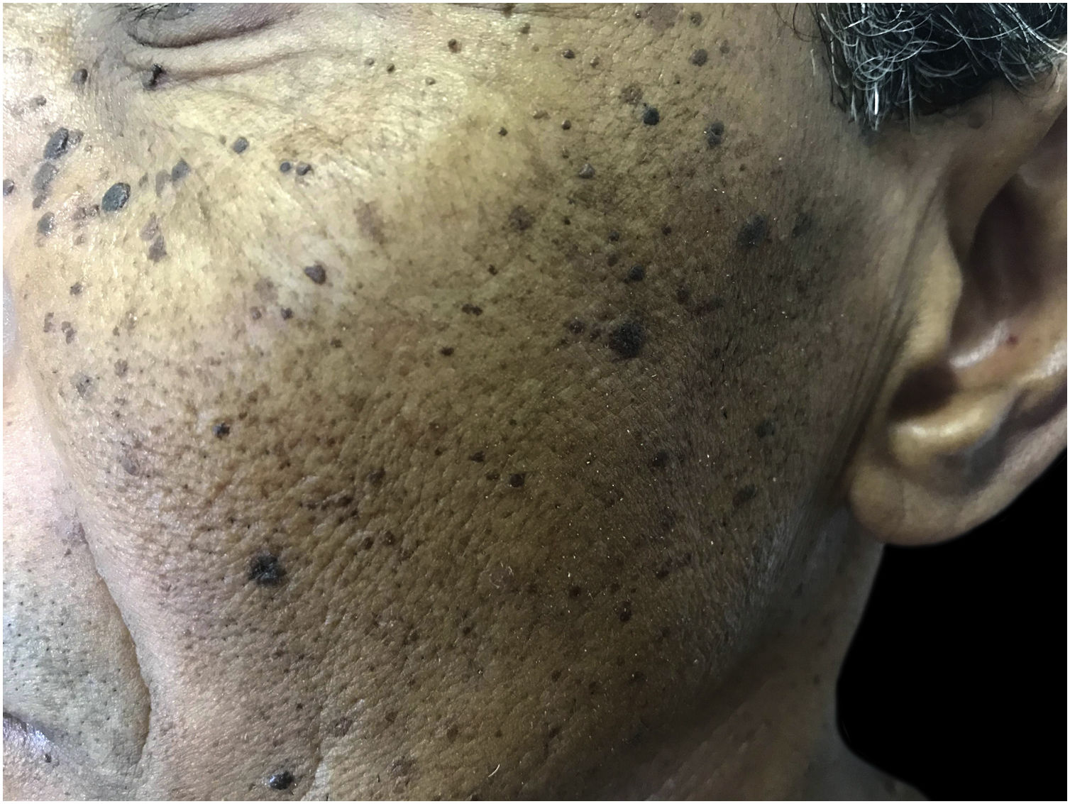 Hyperchromic Rash Dermatology in black skin | Anais Brasileiros de Dermatologia