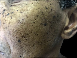 Dermatosis papulosa nigra: hyperchromic papules on the face.