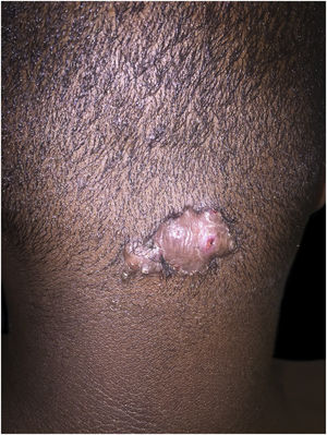 Keloid folliculitis of the neck: sessile nodule on the back of the neck.