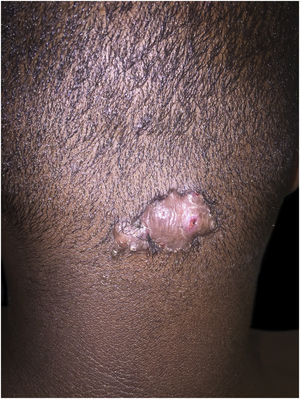 Keloid folliculitis of the neck: sessile nodule on the back of the neck.