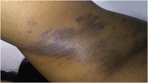 Lichen planus pigmentosus: slightly raised papules and bright hyperchromic macules in the axilla.