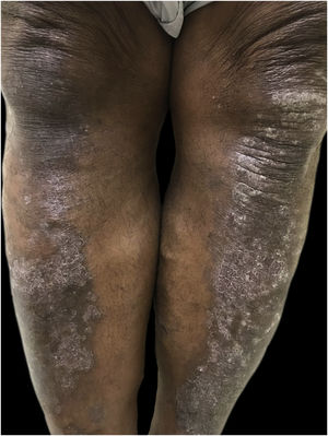 Psoriasis: hyperchromic plaques with thick symmetrical scales on the anterior surface of the legs.