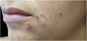 Elegant syphilis: erythematous papule and annular plaque on the face.
