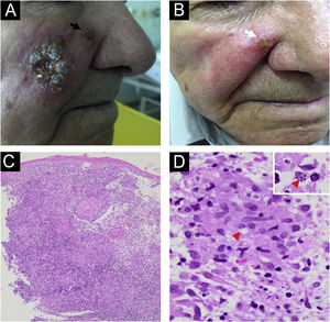 Case 2. (A) An infiltrative plaque of small ulcers and crusts in the right cheek, and a satellite lesion in the nasal border (black arrow). (B) The patient presented great improvement with 1.5 g of liposomal amphotericin. A lasted lesion (white arrow) was treated with cryosurgery using an open probe. (C) Histopathology showing pseudoepitheliomatous hyperplasia and a granulomatous infiltrate in the dermis (Hematoxylin & eosin, 4×). (D) Rare round structures inside macrophages suggesting amastigotes forms can be seen (red arrowhead) (Hematoxylin & eosin, 100×). The insert (right-up corner) shows four amastigotes inside a macrophage.