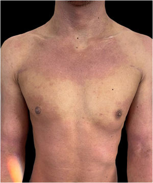Severe, widespread erythematous patches of atopic dermatitis, with different degrees of lichenification.