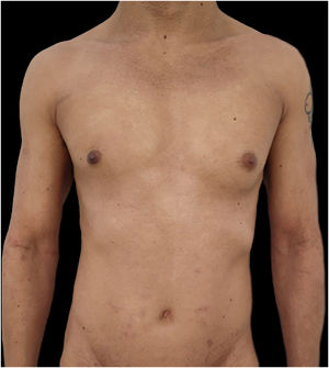Complete skin clearance after 16-weeks of upadacitinib 15 mg daily. Note a few residual hyperchromic macules.