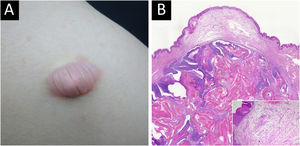 Bullous pilomatricoma. Clinical appearance (A) and histopathological features (B) Chronological stage 2, Hematoxylin & Eosin, scanning view, inset: ×100.