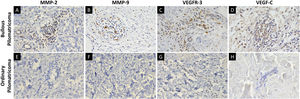 Immunohistochemical staining for MMP-2, MMP-9, VEGFR-3, and VEGF-C in bullous pilomatricoma (A–D) and ordinary pilomatricoma (E–H) with magnification (×400).