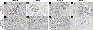 Immunohistochemical staining for MMP-2, MMP-9, VEGFR-3, and VEGF-C in bullous pilomatricoma (A–D) and ordinary pilomatricoma (E–H) with magnification (×400).