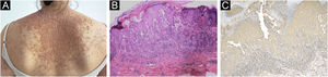 (A) Confluent red miliary papules on the back. (B) The light microscopy showed isolated dyskeratotic cells and spicules with hyperkeratosis and focal hyperkeratosis suggesting Darier disease. (C) Immunostaining with anti‐IL-6 (A11114, 1:200, ABclonal Biotech) showed weakly positive staining (x100).