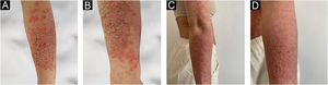 (A‒B) Multiple papules on her forearm. (C‒D) After the treatment marked improvement.