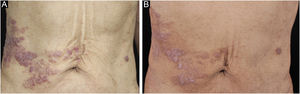 (A) Metameric dark red papules, plaques with infiltration on the right waist and abdomen, corresponding to the right dermatomes of T8‒T10. (B) After 4-months of chemotherapy: infiltration becomes flatter and lighter than before.
