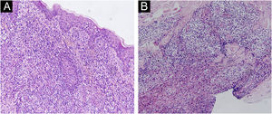(A) Lymphoid cell infiltration in the epidermis and hair follicles, (B) Diffuse lymphocytes and epithelioid cell infiltration in the whole dermis. (Hematoxylin & eosin, ×200).