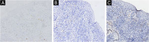 Negative immunohistochemical staining for CD20 (A), Myeloperoxidase (MPO) (B) and CD117 (C) (×200).