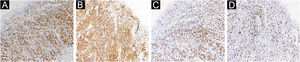 Positive immunohistochemical staining for CD3 (A), CD4 (B), and CD8 (C), Ki 67 was positive in more than 30% of the cells (D) (×200).