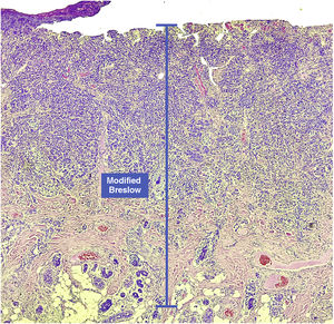 In cases with extensive ulceration, the modified Breslow measurement is taken from the base of the ulcer, as with the conventional Breslow measurement.