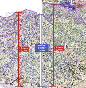 Both cases show an invasive component with similar thickness (1.5 mm, coinciding with the modified Breslow measurement). However, the conventional Breslow measurement is 1.6 mm on the left (thin epidermis) and 1.7 mm on the right (thick epidermis).