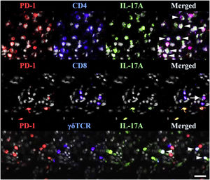 TRMs express PD-1 in psoriasis. PD-1 and IL-17A were costained with CD4, CD8, or TCR γδ. White arrowheads indicate triple-stained cells, and a tailed white arrow indicates IL-17A-PD-1+ CD8 T-cells. Reproduced with the permission of Copyright Clearance Center@Programmed cell death ligand 1 alleviates psoriatic inflammation by suppressing IL-17A production from programmed cell death 1-high T-cells.