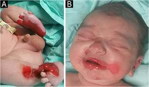 Extensive areas of skin detachment on the anteromedial aspects of both lower extremities (A) and perioral region (B).