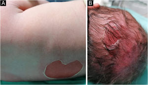 Blistering and skin detachment at trunk (A) and scalp (B).