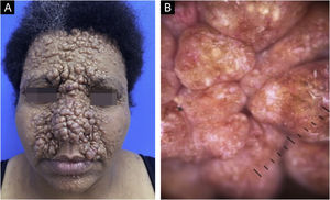 (A) Multiple confluent, normochromic, shiny, well-defined papules and nodules, measuring 0.5 to 2 cm in diameter, located predominantly and symmetrically on the central face; (B) Dermoscopy: arboriform vessels, chrysalises and milium pseudocysts over pink areas.