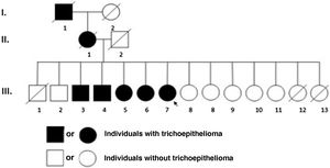 Pedigree showing autosomal dominant inheritance pattern of multiple familial trichoepithelioma.