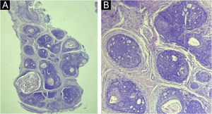 (A) Histopathology: well-defined dermal tumor (trichoepithelioma), consisting of lobules of basaloid cells and focal keratin pseudocysts (Hematoxylin & eosin, ×100). (B) Lobules of basaloid cells, with a peripheral palisade and cribriform pattern, surrounded by fibrotic stroma, associated with focal Keratin pseudocysts. There is direct contact between stroma and tumor cells (Hematoxylin & eosin, ×200).