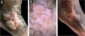 Case 1. (A) Prior to treatment. (B) Dermoscopy: pink lacunae separated by white septa. (C) Outcome four months after excision by shaving.