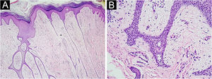 Histopathology of Case 1 stained with Hematoxylin & eosin. (A) ×20 magnification, showing a network of epithelial cords connected to the epidermis. (B) At ×200 magnification, the fibrovascular stroma is observed between the epithelial cords.