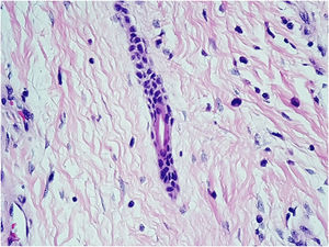 At ×400 magnification. Eccrine duct lumen inside the epithelial cord.