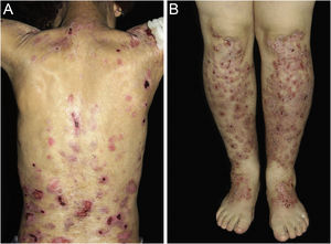 Dominant dystrophic epidermolysis bullosa (DDEB). (A) Generalized form affecting the back. Healing of bullae leads to scarring. (B) Excoriated papules on the lower limbs in pruriginous DEB.