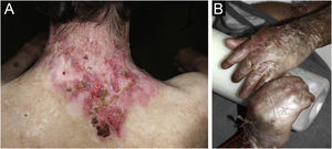 Recessive dystrophic epidermolysis bullosa (RDEB). (A) Bullae and ulcerated areas cause scarring and fibrosis. (B) Pseudosyndactyly of the hands, with fusion digits.