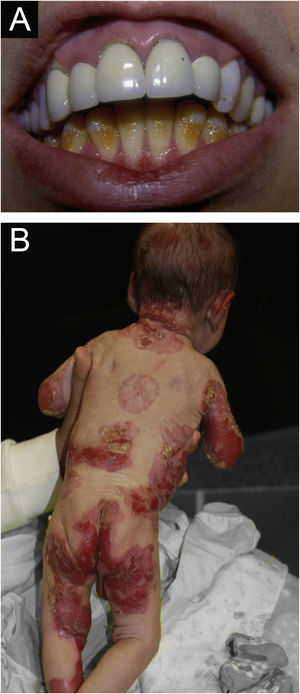 Junctional epidermolysis bullosa (JEB). (A) Dental enamel defects in the lower dental arch, with punctate depressions and yellowish color. In the upper dental arch it is possible to see laminated veneers (dental contact lenses). (B) Baby with skin fragility and denuded areas; other areas with granulation tissue and crusts.