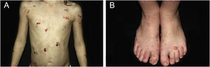 Epidermolysis bullosa simplex (EBS). (A) Child with tense blisters, ulcerations and hematic crusts. Observe the involvement of friction sites (periaxillary region). (B) Healing bullae and erosions on the feet in the localized form of EBS.