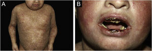 Kindler epidermolysis bullosa (KEB). (A) Scarring lesions with mottled, hypo- and hyperpigmented macules in a child with KEB. (B) Poikiloderma on the face. Crusts and ulcerations on the lips. Teeth in poor condition.