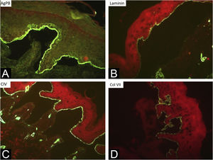 Immunomapping of dominant dystrophic epidermolysis bullosa (DDEB). Observe cleavage in the sublamina densa, with marker deposition and fluorescence on the roof of the bullae. The markers used are: (A) Bullous pemphigoid antigen, (B) laminin, (C) collagen IV and (D) collagen VII.