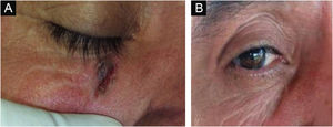 Nodular ulcerative BCC evolution after interferon therapy. Pre-treatment (left). Five-years after treatment (right).