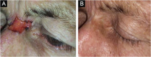 Nodular ulcerative BCC evolution after interferon therapy. Pre-treatment (left). Five-years after treatment (right).