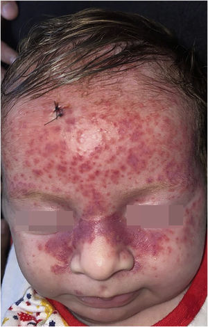 Numerous erythematous-violaceous macules, papules, isolated or confluent, particularly affecting the upper third of the face.