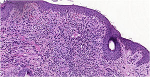 Histopathological examination showing a diffuse histiocytic infiltrate, in the superficial dermis up to the middle portion of the reticular dermis.