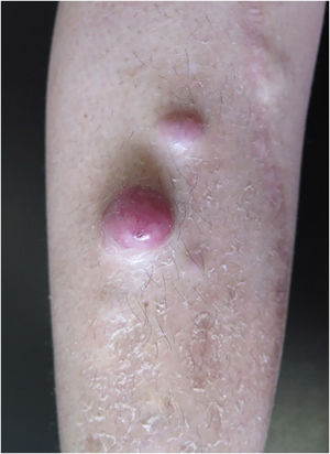 Erythematous tumors on the right pre-tibial region.