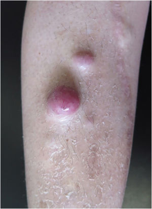 Erythematous tumors on the right pre-tibial region.