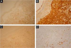Diffuse positivity for C138 in tumor cells (A); diffuse intense KAPPA positivity in the lesion (B); focal positive CD79A (C); focal positive CD79A – higher magnification (D).